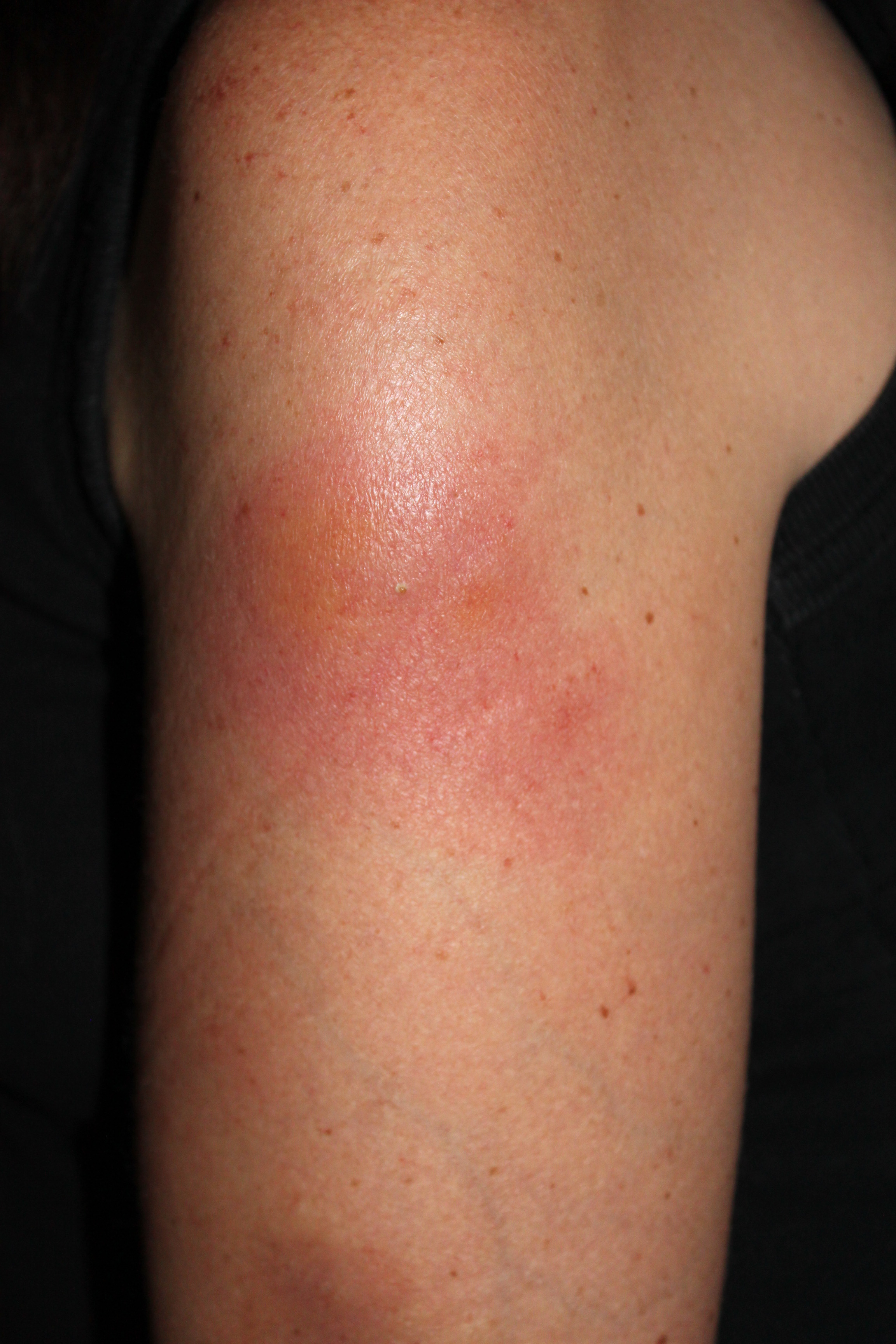 Lower Leg Rash - Dermatology - MedHelp